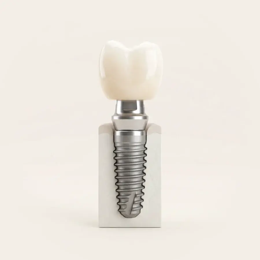 Implante dentário
